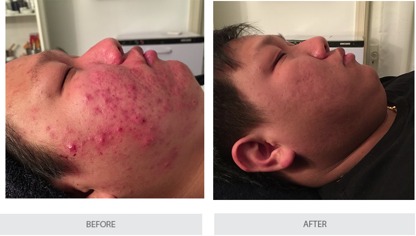 Acne Skin Care Before and After