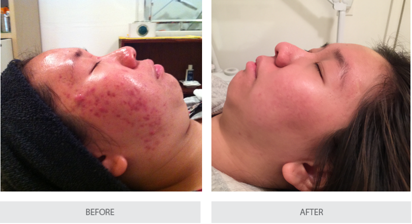 Before and After Facial - Acne Removal