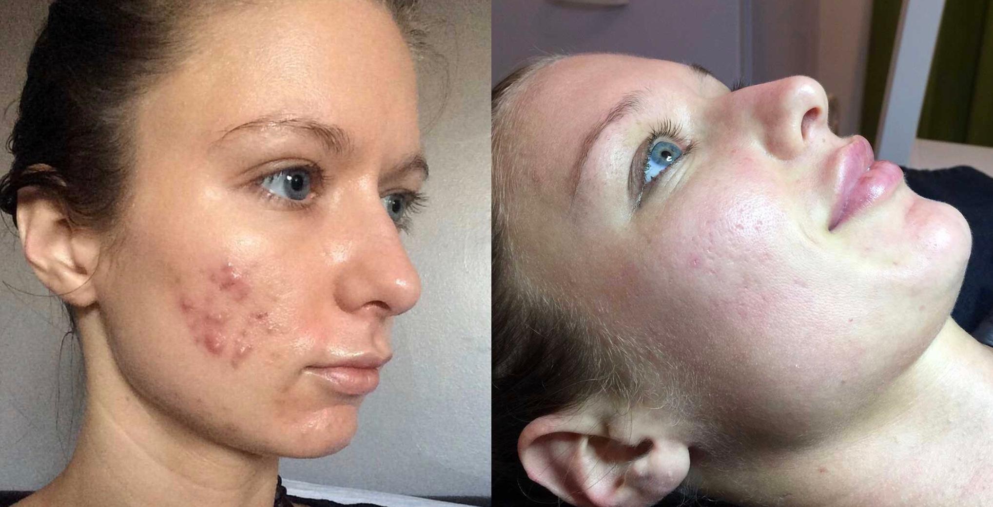 Acne Stop Facial Before and After